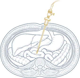 Anatomical diagram of a laparoscope examining the abdominal cavity